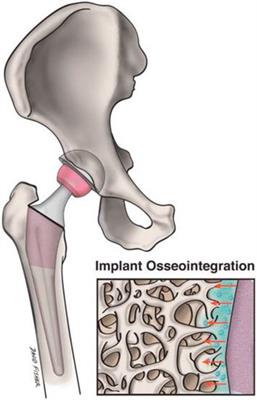 A mini-review on the emerging role of nanotechnology in revolutionizing orthopedic surgery: challenges and the road ahead